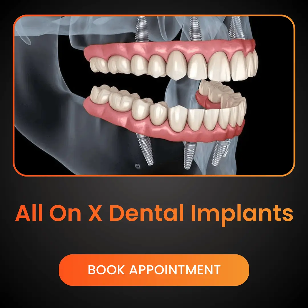 All-On-X-Dental-Implants.webp