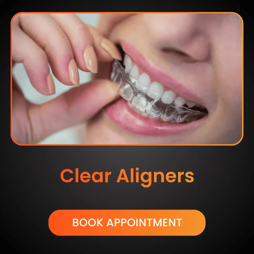 Clear-Aligners.webp