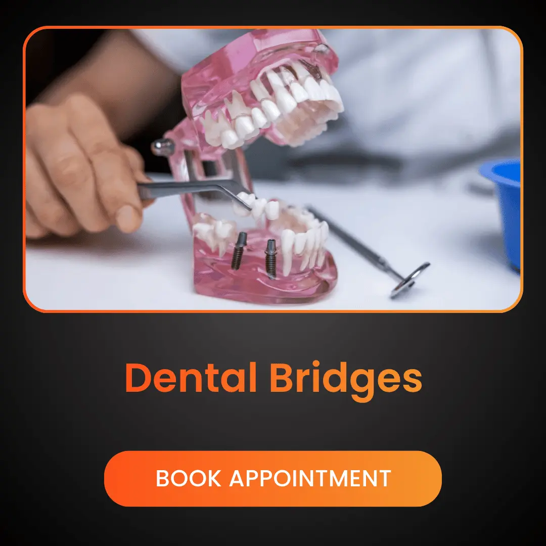 Dental-Bridges.webp