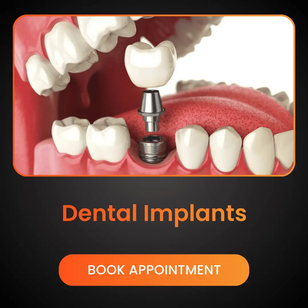 Dental-Implants.webp