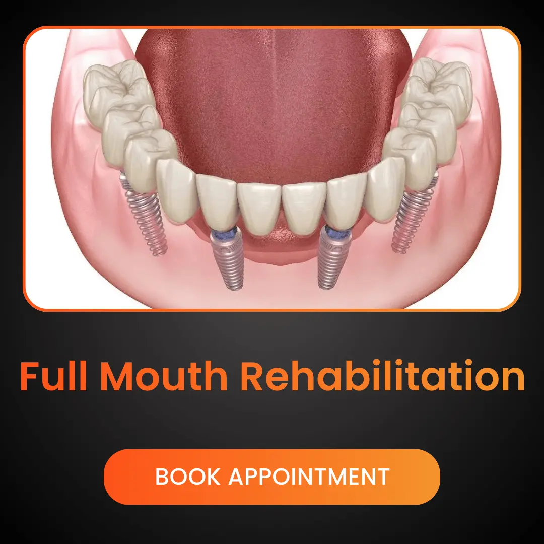 Full-Mouth-Rehabilitation.webp