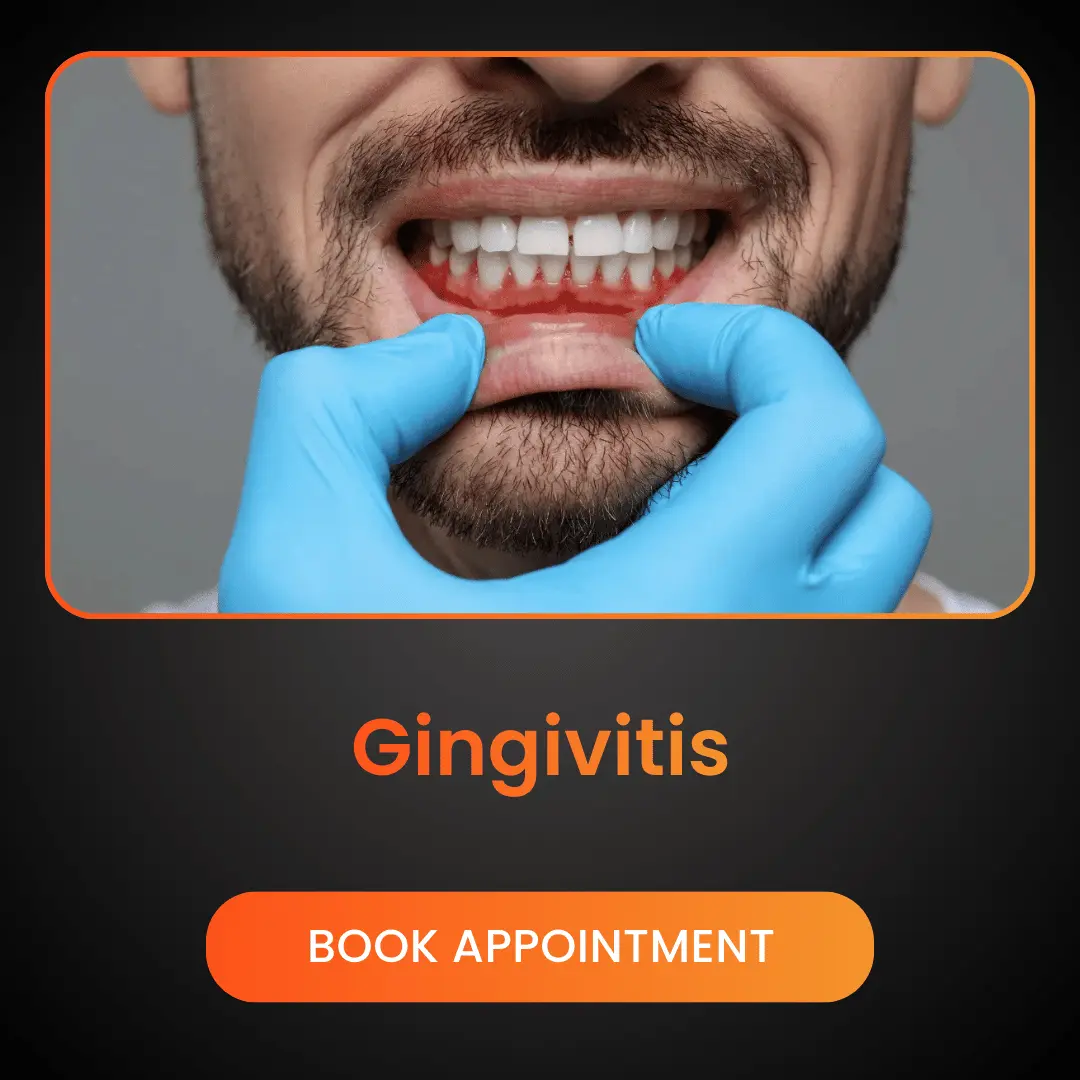 Gingivitis-1.webp