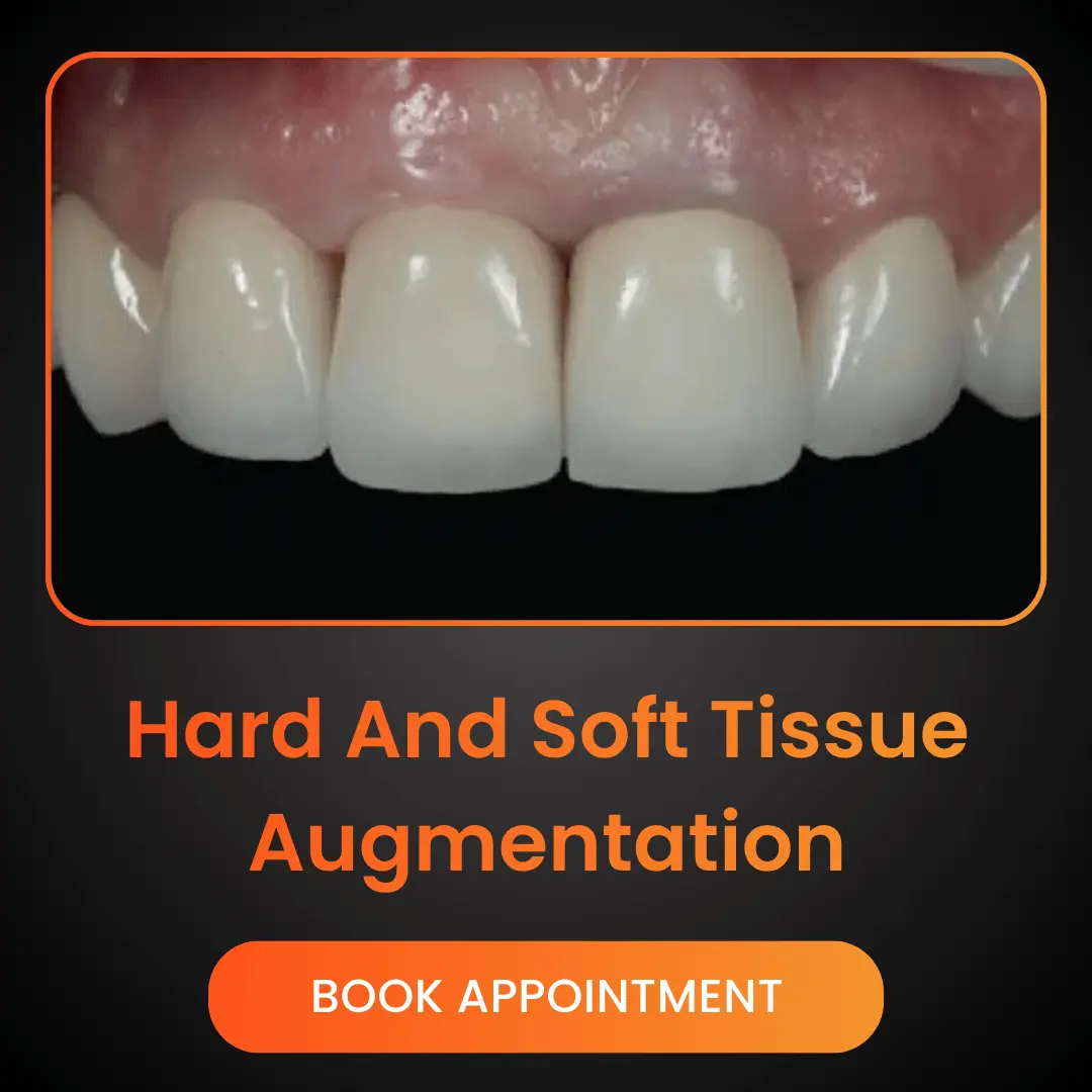 Hard-And-Soft-Tissue-Augmentation.webp