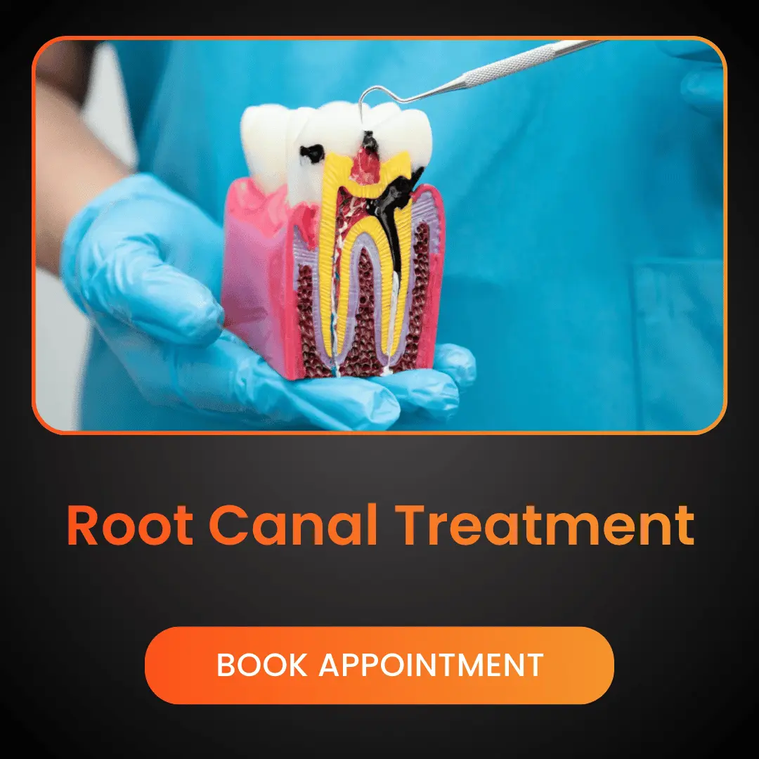 Root-Canal-Treatment-1.webp