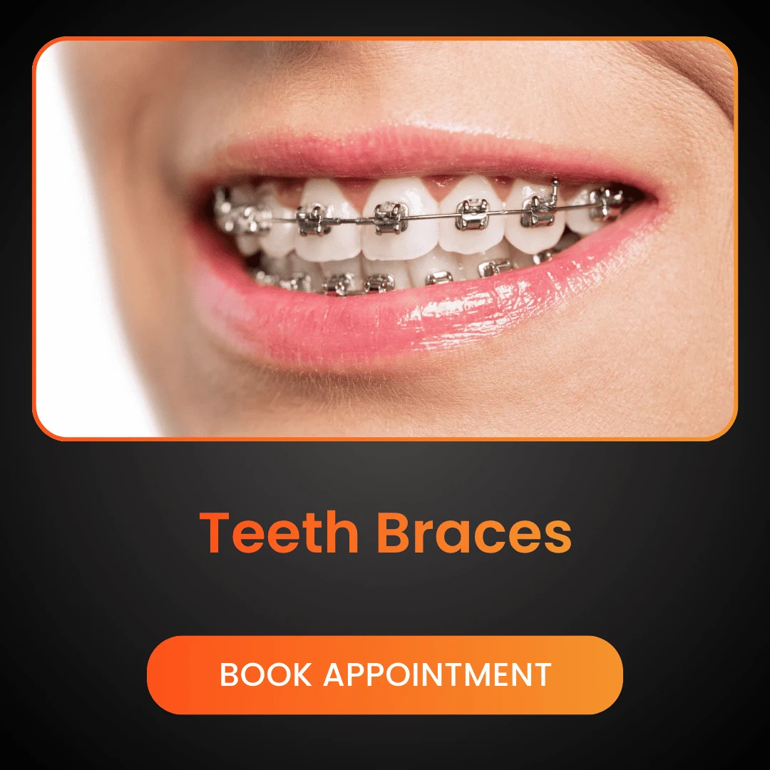 Teeth-Braces.webp