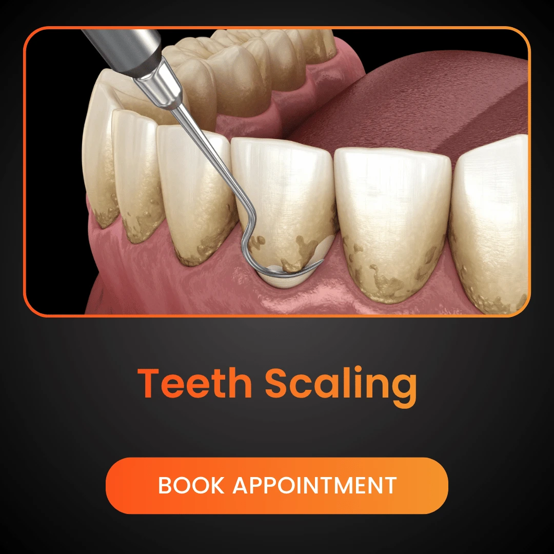 Teeth-Scaling.webp