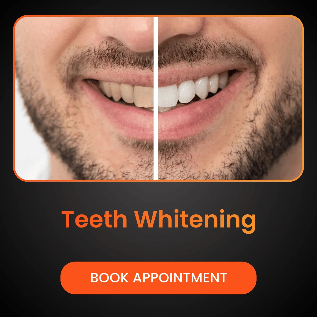 Teeth-Whitening-1.webp