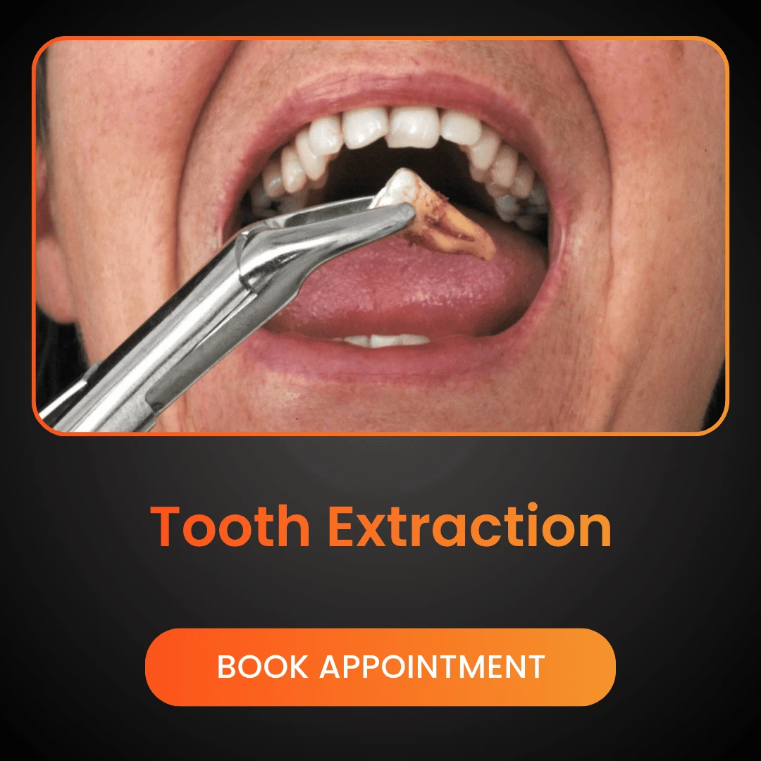 Tooth-Extraction.webp